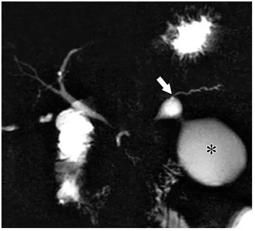 急性胰腺炎影像检查首选,急性坏死胰腺炎影像