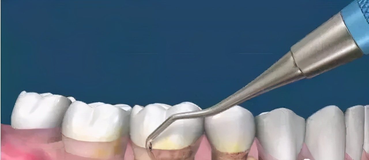 每年对牙齿清洁一次对牙齿有害吗,每年一次洗牙结石对牙有伤害吗