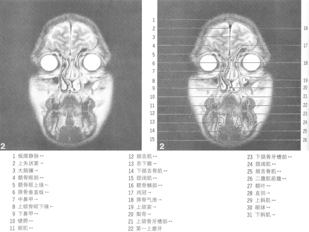 颅脑冠状状切面解剖图,颅脑mr解剖结构图
