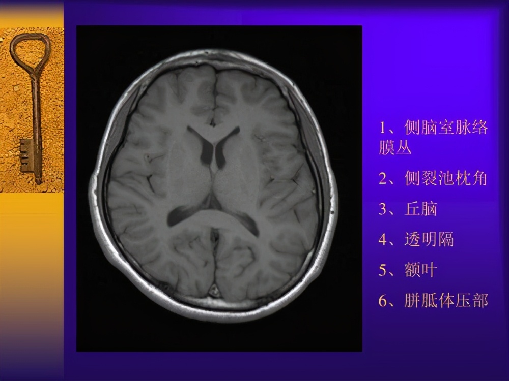 额叶肿瘤有什么特征,少突胶质细胞瘤多发于额叶