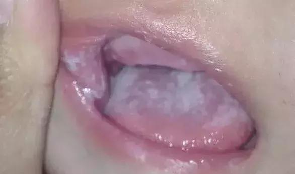 宝宝嘴巴有小白点怎么回事,扁桃体有白点无症状会自愈吗