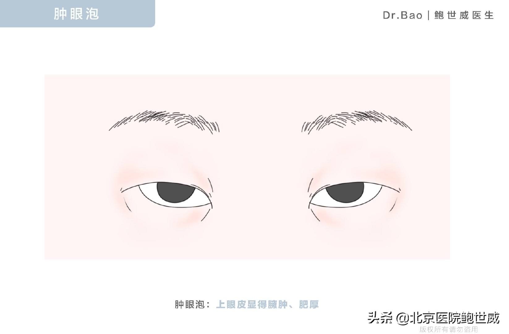 肿眼泡不解决会怎么办,肿眼泡睁不开怎么办