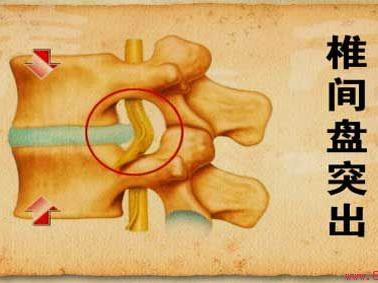 腰三横突综合征疼痛缓解方法,第三腰突综合症腰疼怎么治疗
