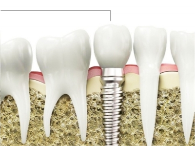 口腔医疗之种植牙行业专题,口腔医疗设备的发展趋势
