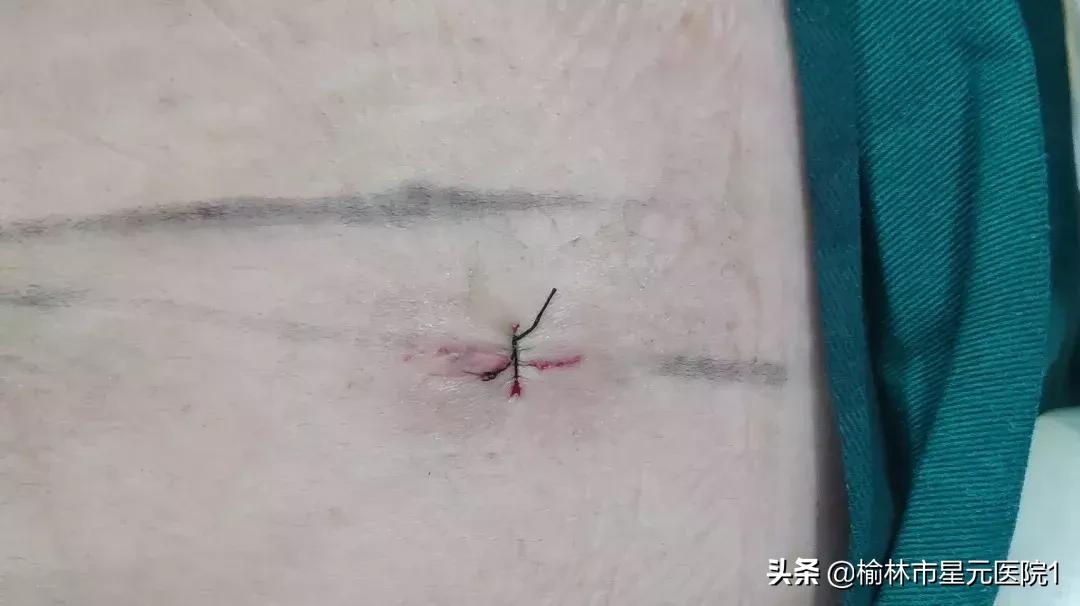 榆林佳县治疗腰椎间盘突出,榆林腰椎间盘突出最有效治疗