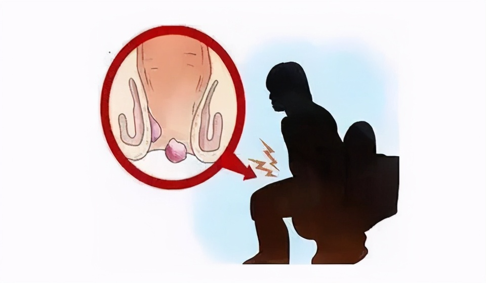 肛门口有块软软的肉怎么回事,肛门口有个软软的肉疙瘩是什么