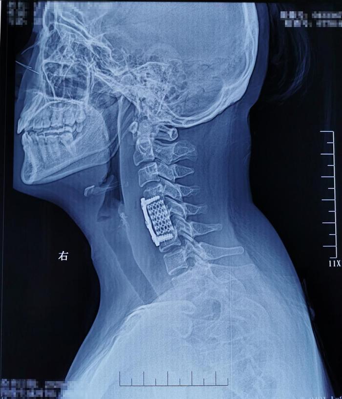 因颈背部疼痛、上臂抽疼,检查出颈5椎体结核