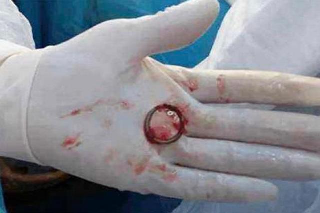 给女性上环到底正不正确,女性避孕上环的好处和坏处