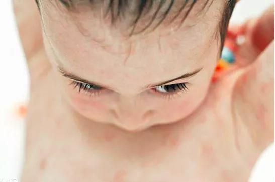 宝宝湿疹反复涂药都不好,孩子湿疹痒老抓破皮肤