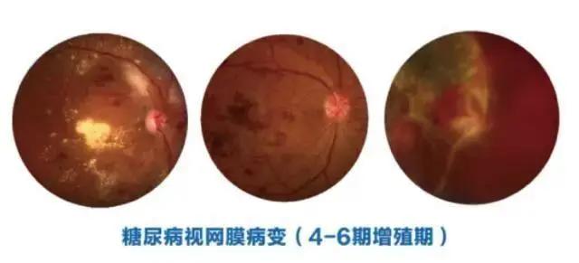 老人视力模糊眼睛失明怎么救治,八旬老人双目失明怎么办