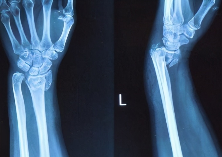 掰手腕粉碎性骨折,男子掰手腕骨折视频