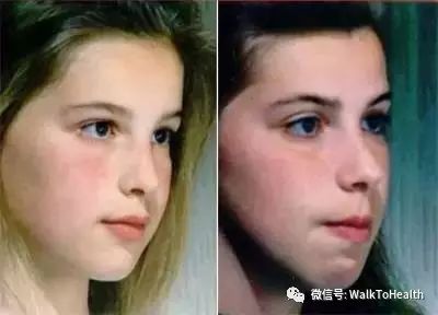 别让口呼吸毁掉你的颜值,脸毁了怎么补救