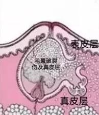 红痘印和黑痘印该怎么祛除,红痘印黑痘印都可以用的药膏