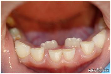 1岁娃才长出4颗牙，就全都烂掉！华西口腔邹静教授：可能妈妈孕期缺营养