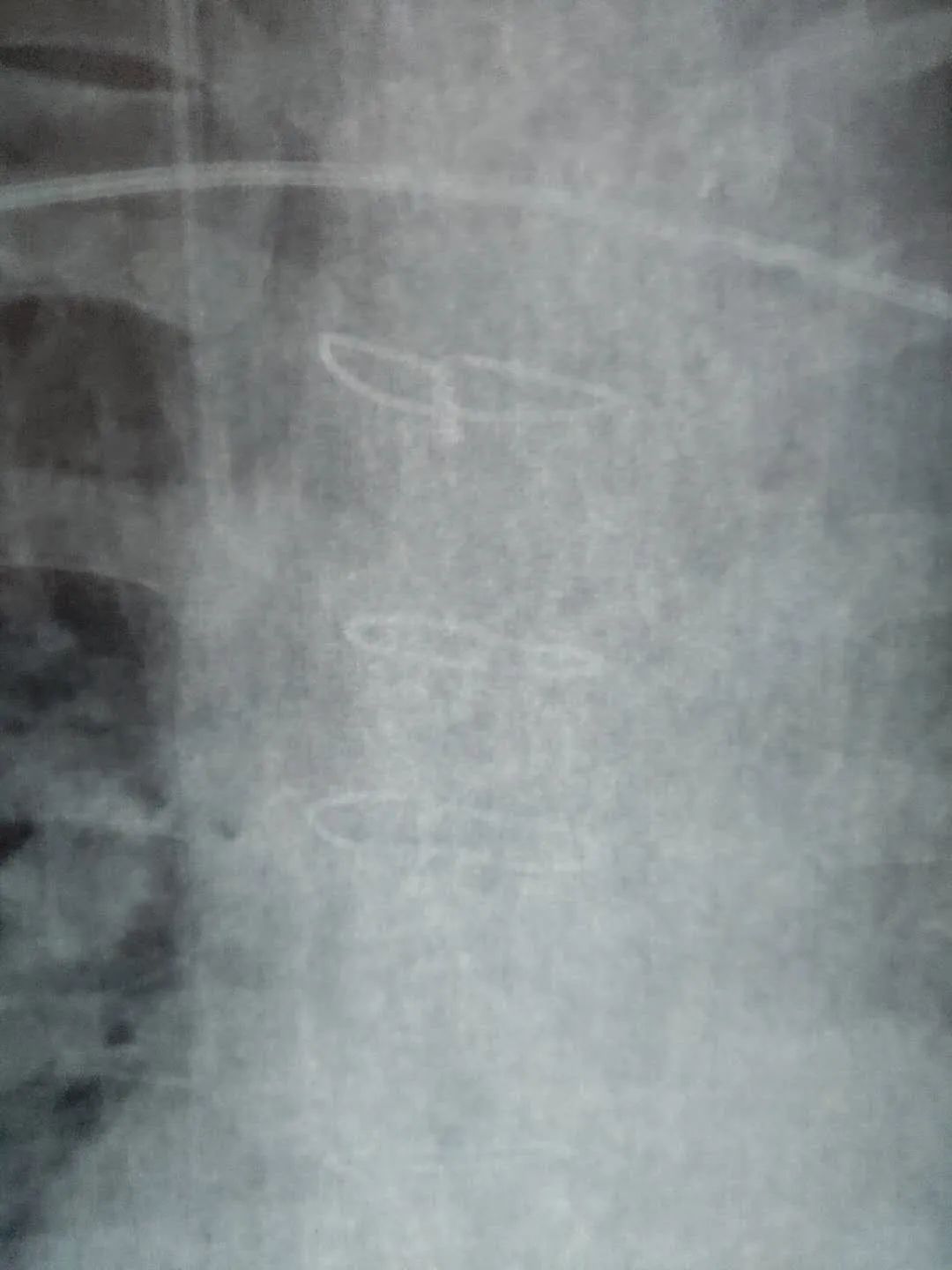 做完锥切和普通人一样吗,开胸手术的患者自述