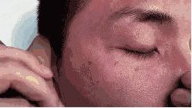 眼袋是不是只有手术才能去除,手术去除眼袋与激光去眼袋哪个好