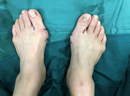 20岁脚趾外翻矫正,踇外翻的处理过程视频