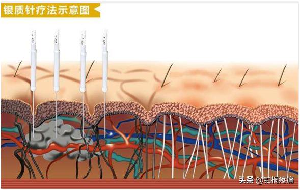 肩周炎胳膊疼的抬不起来怎么治疗,肩周炎手臂粘连抬不起来治疗方法