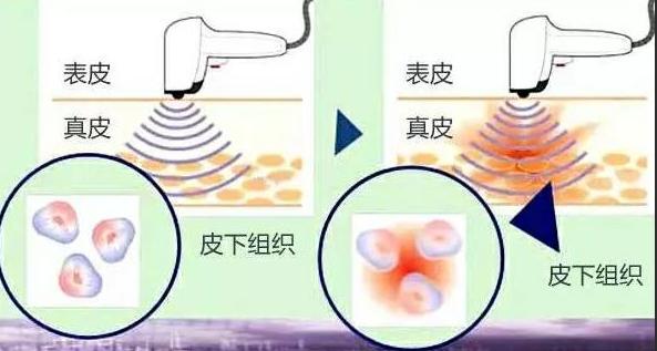 科普|光子嫩肤全攻略,做了光子后禁忌事项有哪些?