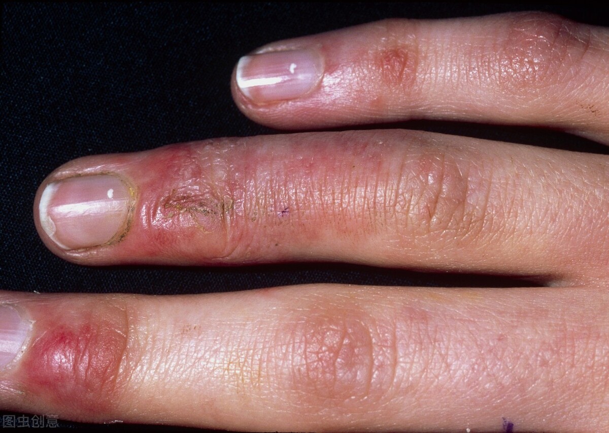 严重冻伤有什么后果,严重冻伤及时处理方法