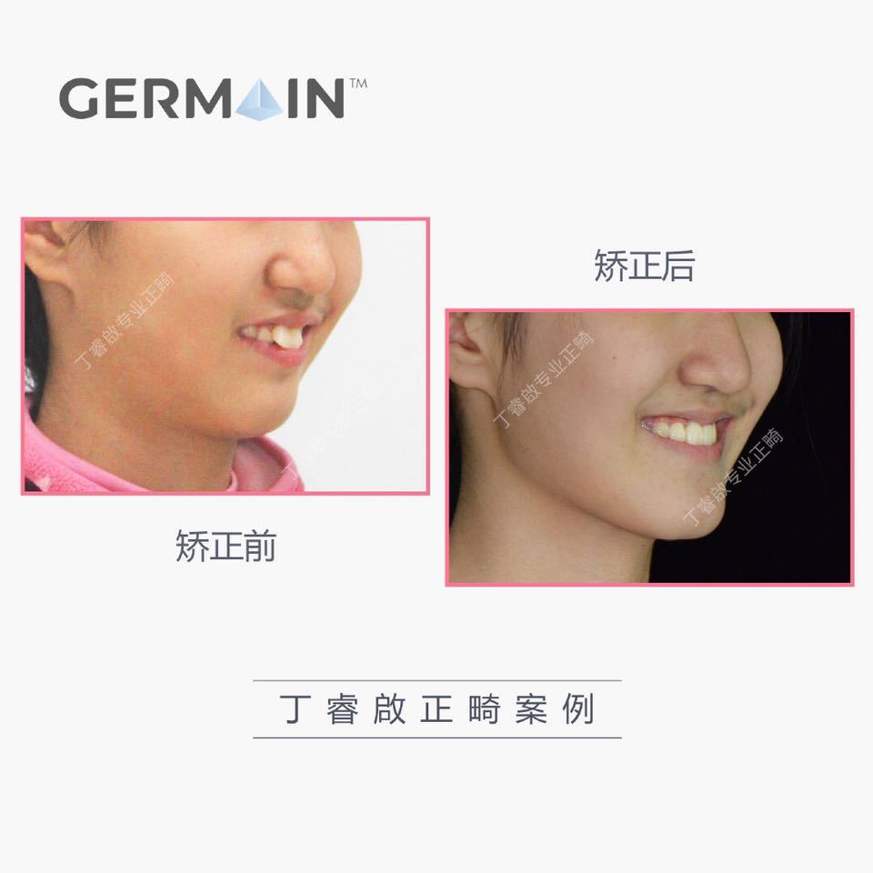 郑州牙齿矫正丁睿啟|下巴后缩病例合集