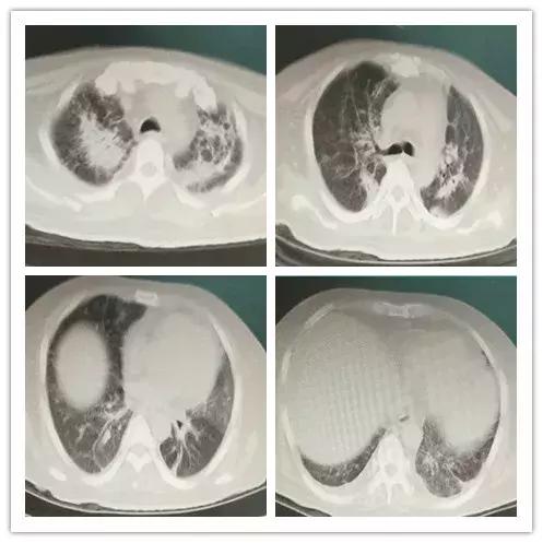 罕见病误诊的真实案例,误诊漏诊导致病人肿瘤癌变