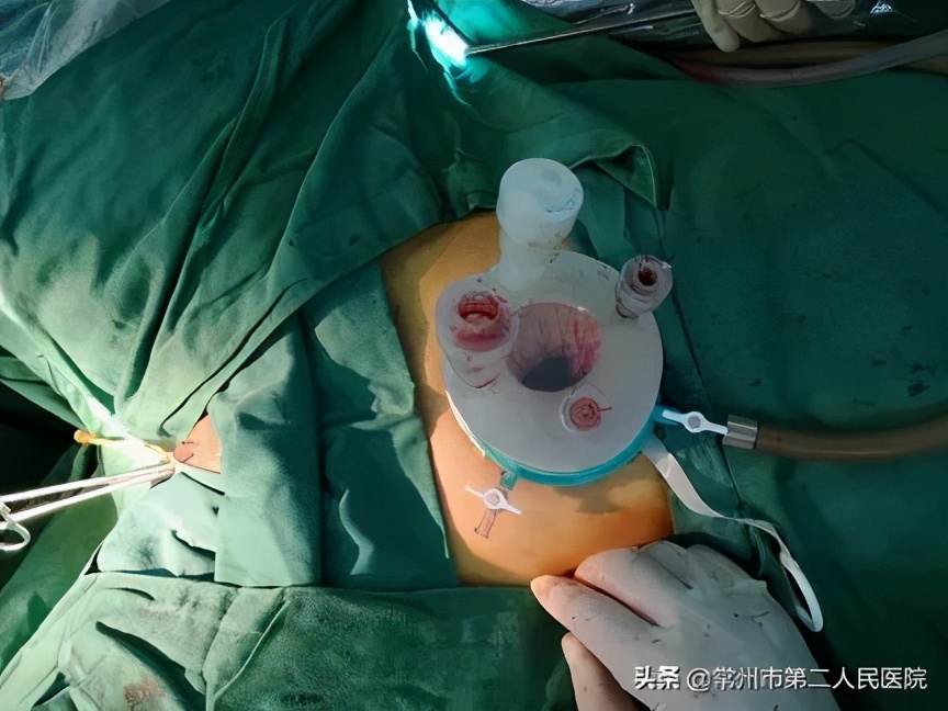 常州二院妇科：安全高效美丽无痕“微创”与“美容”完美结合