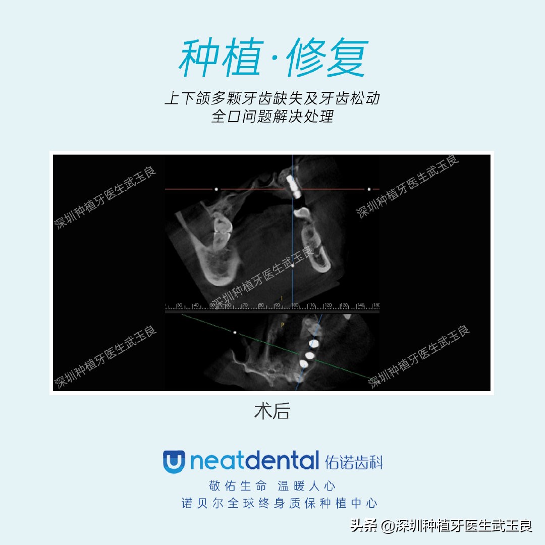 多颗牙齿缺失怎么修复全过程,多颗缺失牙修复案例