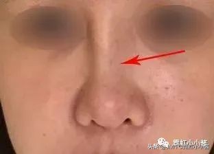 鼻子怎么修复好看呢,鼻型修复方法大全