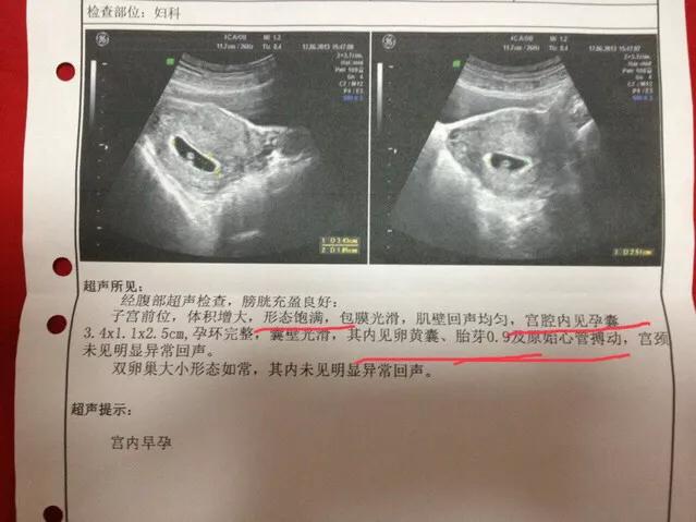 胎儿如何检查智力发育,b超单怎么看出胎儿boy还是girl