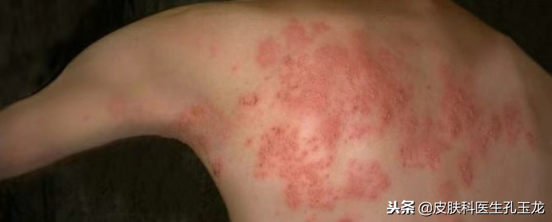皮肤科常见疾病系列:带状疱疹后遗神经痛的治疗汇总