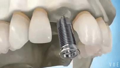 门牙掉了种植牙好还是烤瓷牙美观,门牙缺失两颗做烤瓷牙还是种植牙