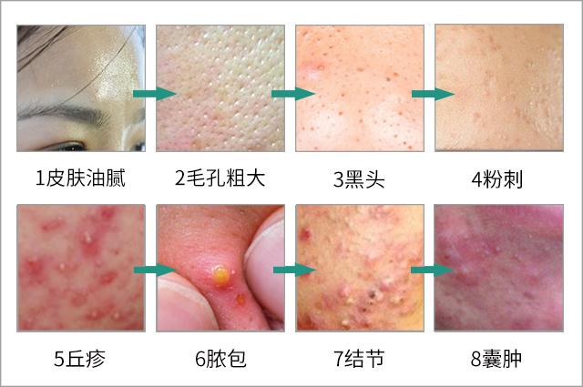 脸上螨虫的正确消灭方法,脸上的螨虫能不能彻底消灭