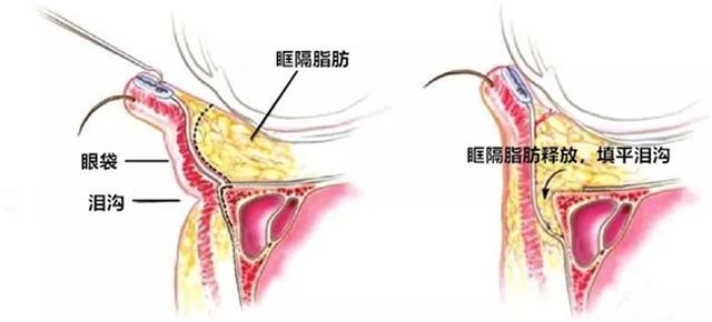 关于泪沟告诉你三个绝招,新手好上手的遮泪沟方法