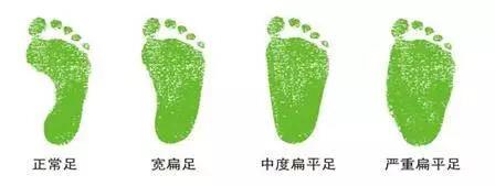 什么是扁平足？日常生活要怎样预防呢？