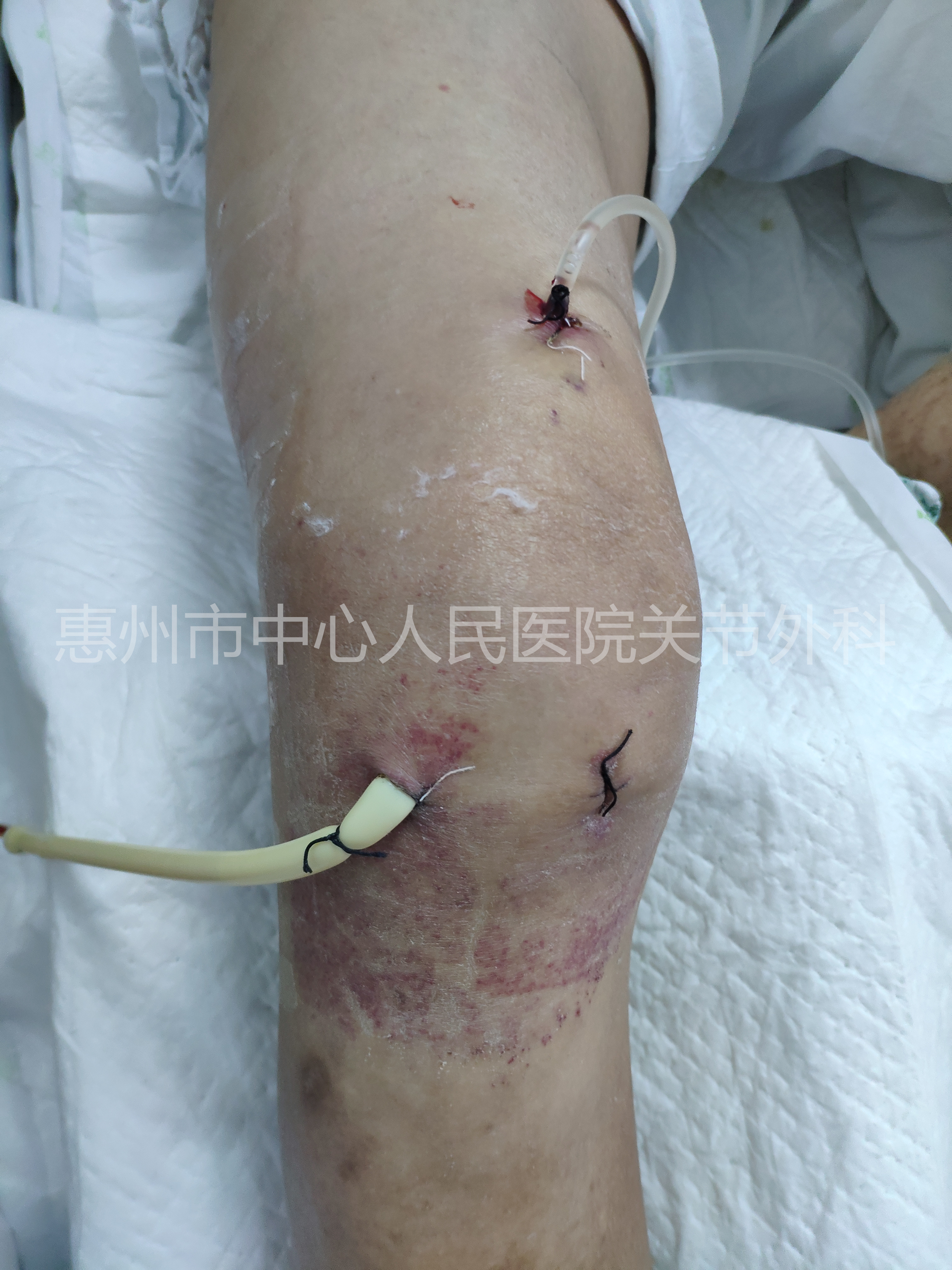 “关节炎”骨科科普逐个说之“化脓性关节炎”