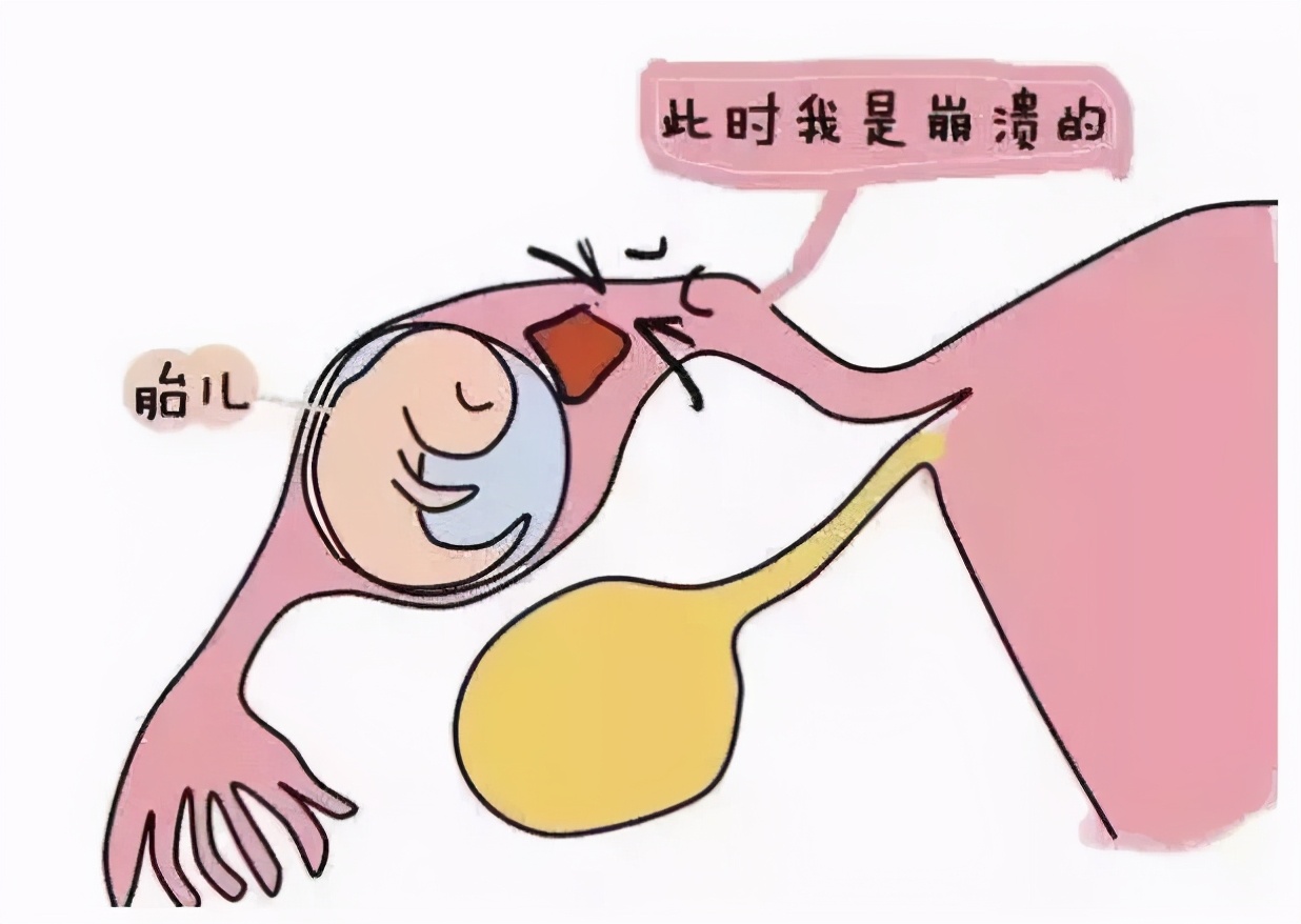 宫外孕发生之前有什么征兆？出现这两种情况要注意