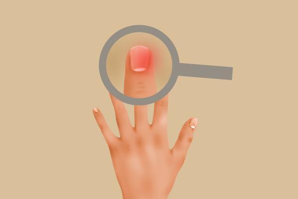 指甲上面没有白色的月牙怎么回事,指甲有竖纹起倒刺是缺什么