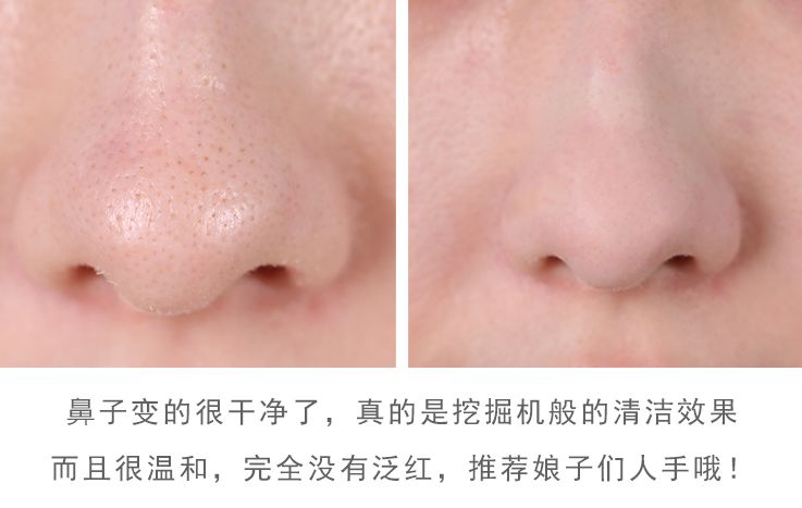 亲测真正有效去黑头粉刺产品,黑头连根拔起还会再长吗