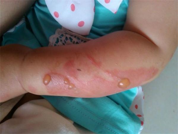 宝宝被火烧伤了怎么处理,孩子被火烧烫伤怎么办