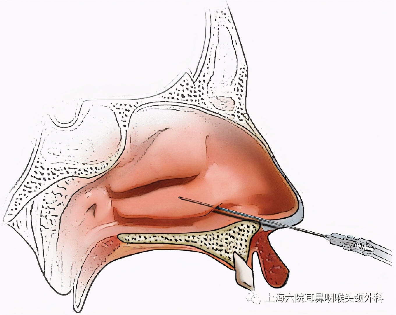 上颌窦炎穿刺手术全过程,上颌窦炎一般小门诊能治疗吗