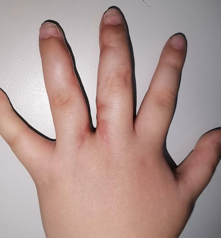 并指手术不植皮新技术,儿童并指免植皮案例