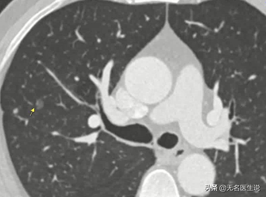 癌症的癌细胞,肺部原位癌是癌症吗
