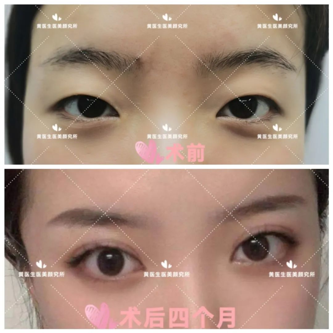 微创双眼皮10毫米,微创双眼皮切口一般多久愈合