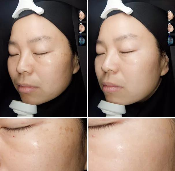 瞬间让脸变白的神器,让斑快速消失