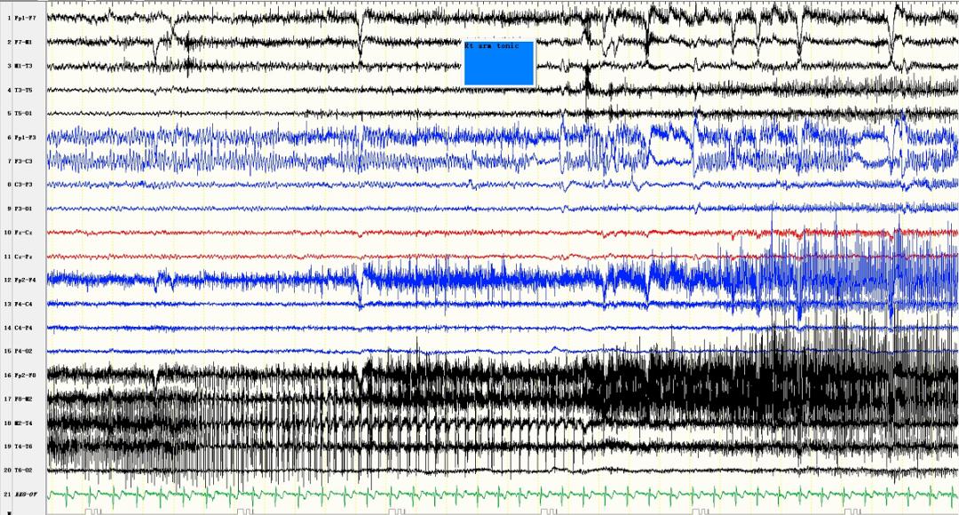 癫痫自行停药后复发用药量,癫痫擅自停药3天后发作