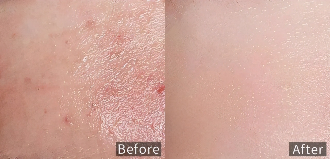 兰屋护肤小知识：刷酸这么神奇，要来试试吗？