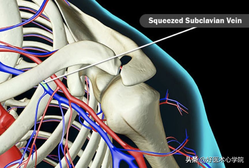 最常见的血栓类型是,最致命血栓视频