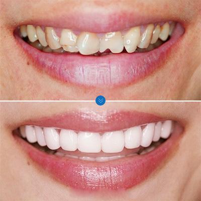 长期嗑瓜子形成瓜子牙可以修复吗,嗑瓜子把牙磕豁了怎么办