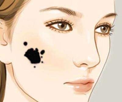 去除黑毛痣手术能医保报销吗,黑毛痣胎记激光能彻底去除吗